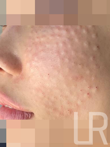 [Lari Plastic Surgery] Rejuran Treatments That Help Strengthen Your Skin’s Natural Ability to Become Healthy Begin at Lari Plastic Surgery. image 2