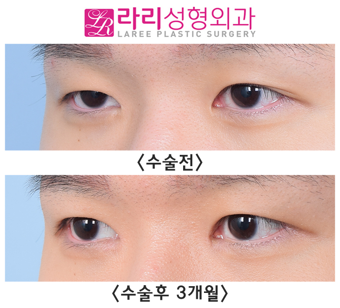 [Rari Plastic Surgery] Pre- and Post-Operation Photos of Uneven Double-Eyelid Correction and Double-Eyelid Removal on Different Sides image 5