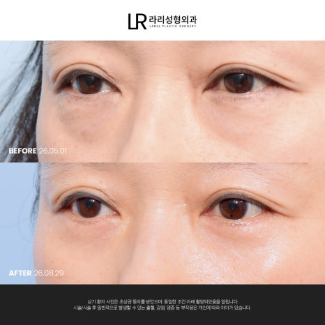 [라리성형외과] 눈 밑이 피곤해 보이는데 눈 밑에 지방만 빼면 될까?(눈밑지방재배치수술 VS 하안검수술) 관련 이미지 7