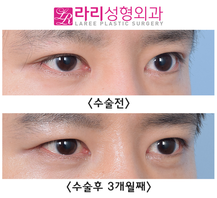 [라리성형외과] 눈매교정 부작용 토안 교정하면서 동시에 쌍꺼풀없애는수술까지 관련 이미지 3