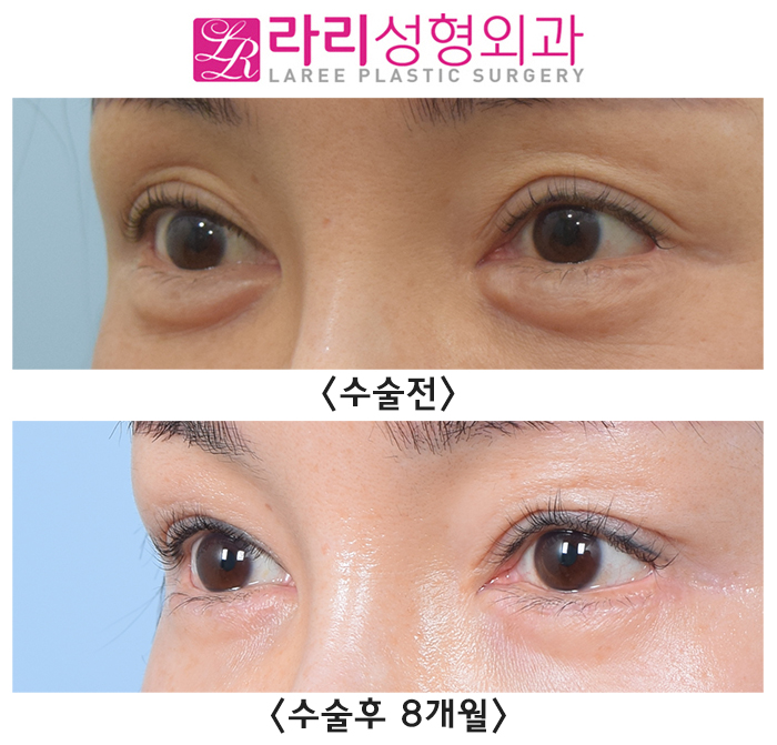 [Laree Plastic Surgery] Aegyo Filler? Permanent Filler? No More Foreign Materials image 5