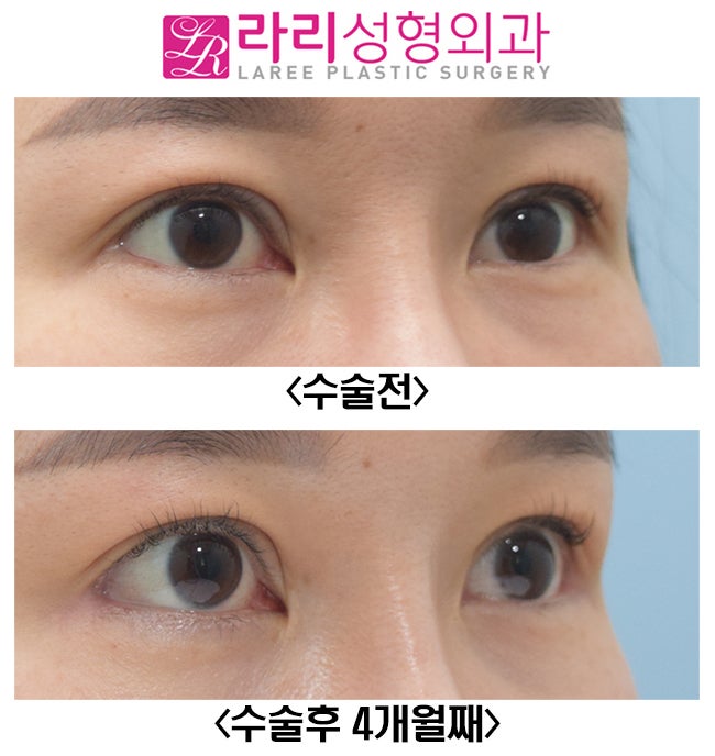 [라리성형외과] 밑트임복원, 뒤트임재수술 전후 사진 관련 이미지 4