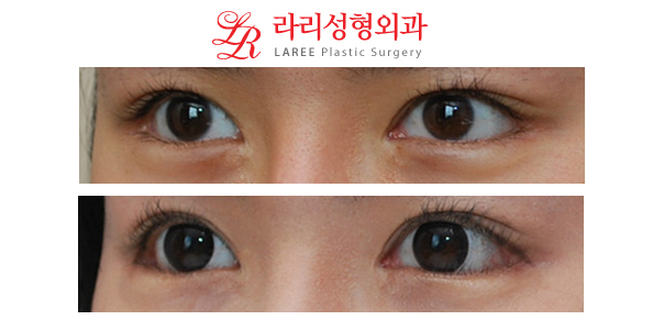 부작용없는 눈꼬리내리기뒤트임재수술 효과 관련 이미지 2