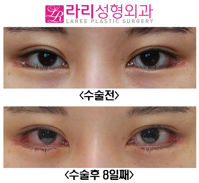[라리성형외과] 속눈썹찔림, 안검내반교정수술이 필요할 때. 관련 이미지 1
