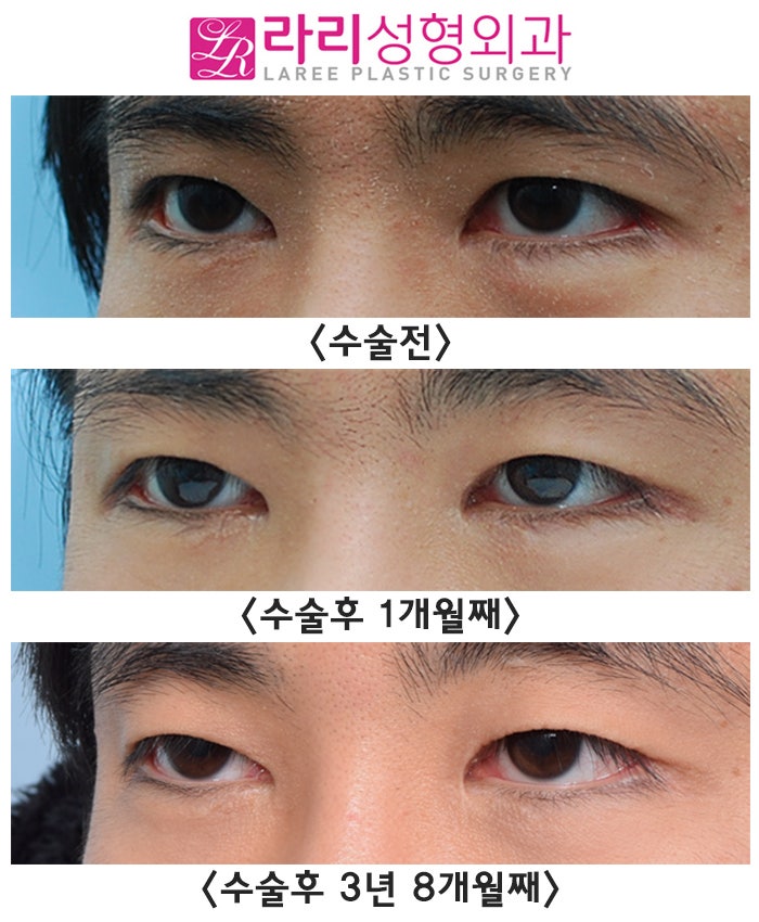 [Rari Plastic Surgery] Before-and-After Photos of Natural Epicanthoplasty Revision Surgery Without Eye Shrinkage or Recurrence image 2