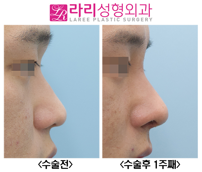 [Lari Plastic Surgery] Before-and-After Photos of Male Rhinoplasty with Rib Cartilage image 1