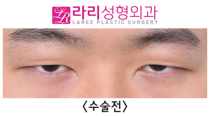 [Lari Plastic Surgery] Before-and-After Comparison Photos of Incisional Eye Correction Surgery That Restores Vision — Not from an Ophthalmology Clinic, but from a Plastic Surgery Clinic image 2