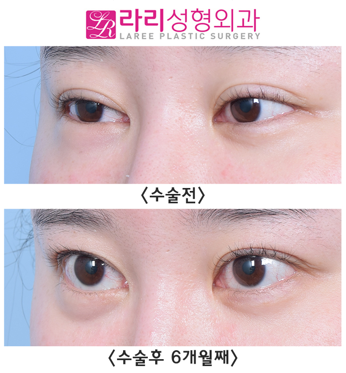 [라리성형외과] 눈밑이물질(스컬트라)제거 수술 전후 사진 차이 관련 이미지 4