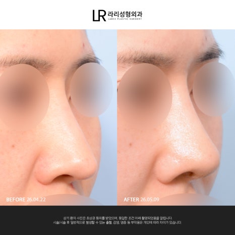[Lari Plastic Surgery] If You Are Considering Nose Surgery, Do Not Get Nose Thread-Lifting Procedures Like Misko / Hiko!! image 13