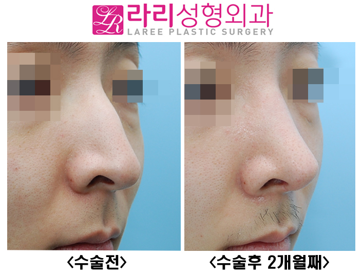 [Lari Plastic Surgery] Hump Nose Surgery Without an Implant image 2