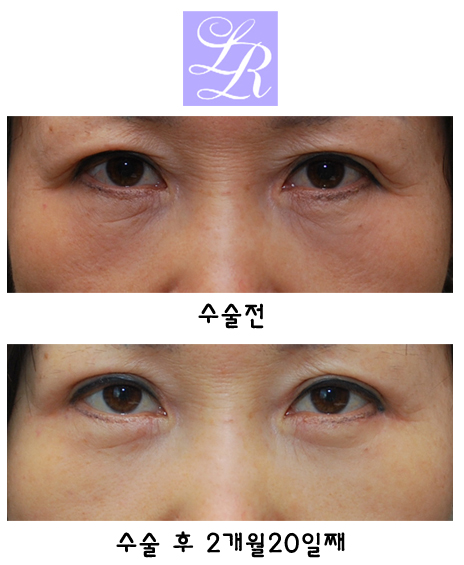 하안검수술,잘 알고 시행해야 관련 이미지 1