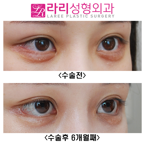 [Rari Plastic Surgery] If You Want a Successful Lower Canthoplasty, NO to Aegyo Filler image 2