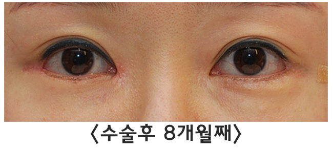 [Lali Plastic Surgery] Comparison Photos of the Before-and-After Differences of Epicanthoplasty Restoration, Revision Lateral Canthoplasty, and Fat Graft Removal Surgery (Under-Eye + Cheekbone Area) image 3