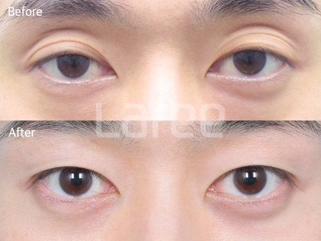 [Lari Plastic Surgery] Eyelid Fat Grafting for Improving the Eyelid Hollow: Incision Method vs. Non-Incision Method image 2