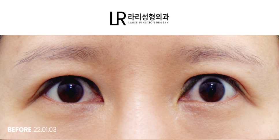 [라리성형외과]  부리부리한 사백안 눈 토안, 이런 눈도 교정 가능할까요 ? 관련 이미지 1