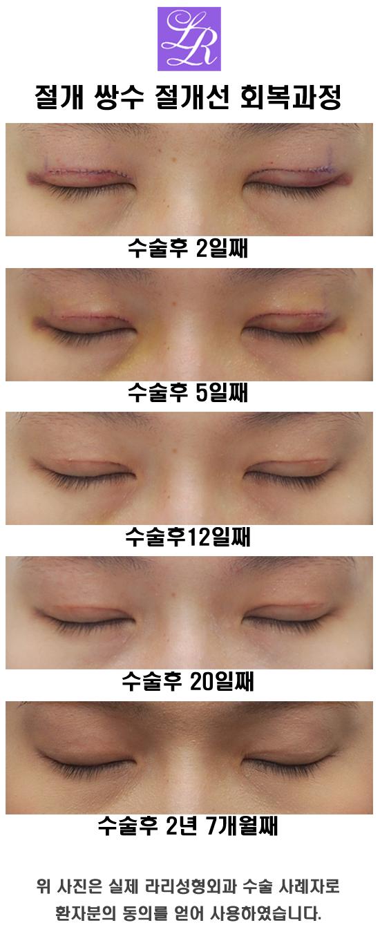Double Eyelid Surgery, Eye Plastic Surgery: Questions About Washing Hair and Eye Makeup image 4