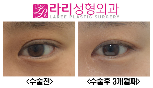 [Lari Plastic Surgery] Cutting Away the Epicanthal Fold: No-Canthus-Opening Surgery Instead of Epicanthoplasty image 1