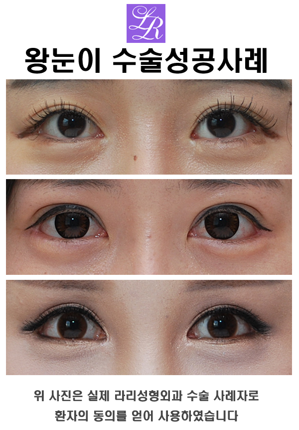 꼬막눈 쌍수 - 짧은눈 왕눈이 수술 관련 이미지 5