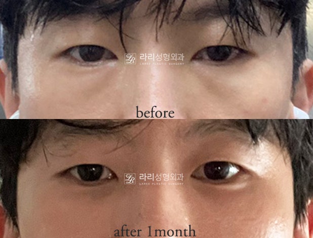 [Lari Plastic Surgery] For Bulging Under-Eyes That Eye Bag Creams / Eye Bag Patches Can’t Fix: Lower Eyelid Fat Repositioning! image 4
