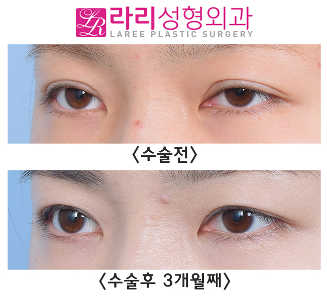 [라리성형외과] 쌍꺼풀재수술 라인낮추기 회복 기간 필수! 관련 이미지 2