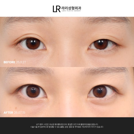 [라리성형외과] 쌍꺼풀수술 전후 사진으로 보는 눈매교정의 중요성 관련 이미지 3