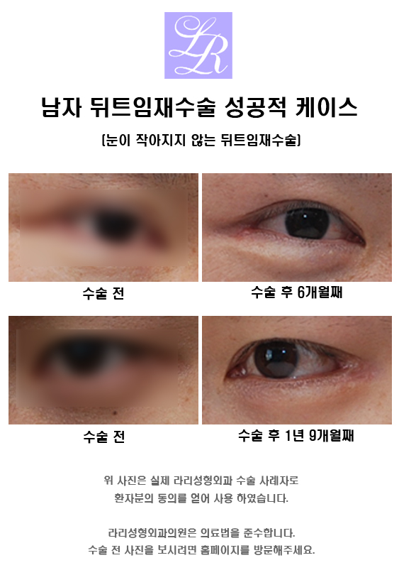 눈이 작아지지 않는 뒤트임재수술 관련 이미지 4