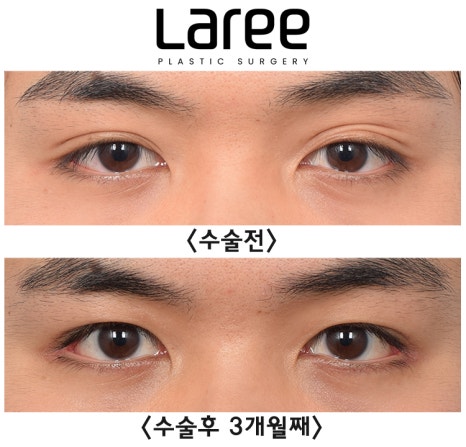 [Lari Plastic Surgery] A Collection of Various Surgeries for Double Eyelids image 7