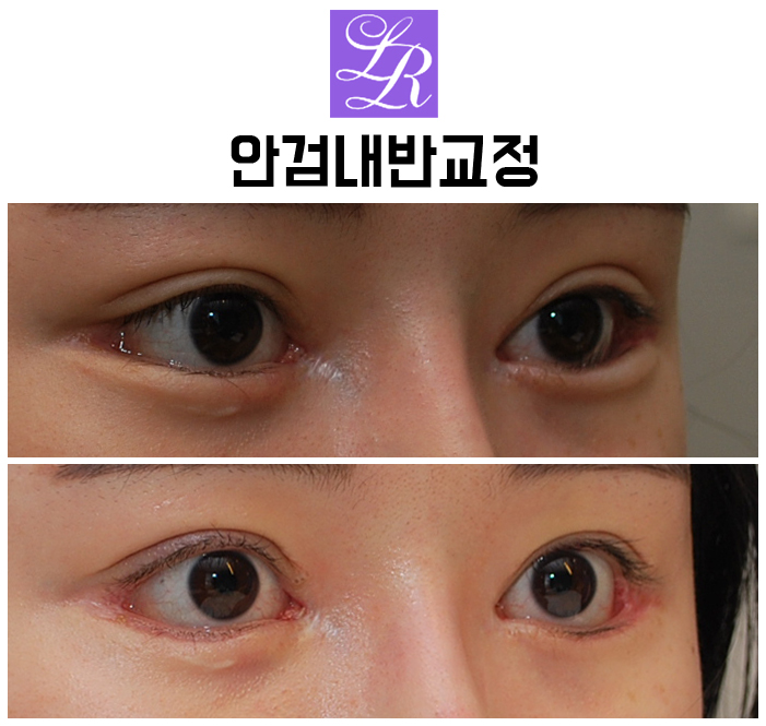 Can Lower-Eyelid Surgery and Entropion Correction Be Done at the Same Time? image 5