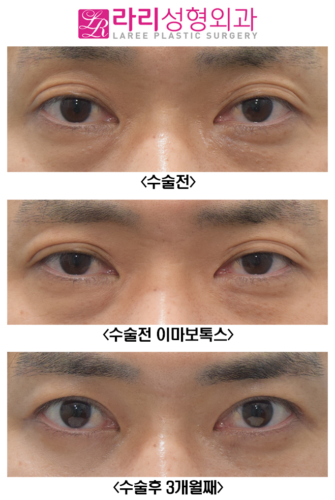 [라리성형외과] 여러겹 쌍꺼풀 제거 관련 이미지 2