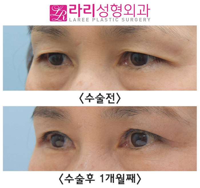 [라리성형외과] 처진 피부에 가려진 내 큰 눈 찾아주는 상안검수술 전후 사진 관련 이미지 2