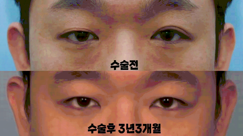 [라리성형외과] 쌍꺼풀없애기 무쌍수술, 자연스러운 변화와 눈 깜빡임을 확인하세요. 관련 이미지 6
