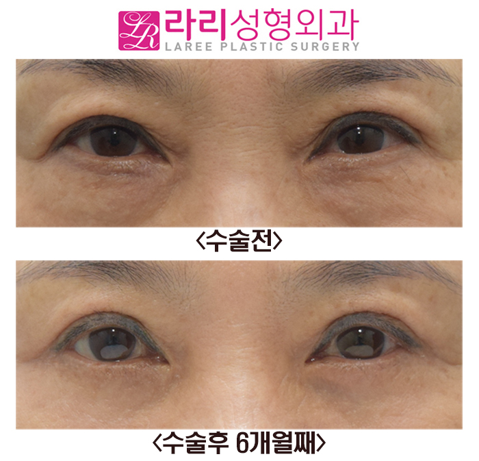 [라리성형외과] 상안검수술과 하안검수술 전후 사진 관련 이미지 1