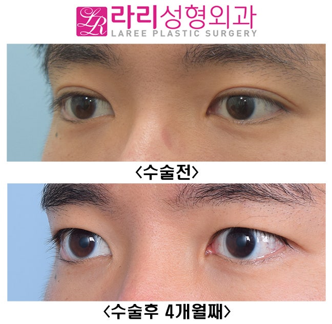 [라리성형외과] 성공적인 쌍꺼풀없애는수술 전후 사진과 효과 관련 이미지 3