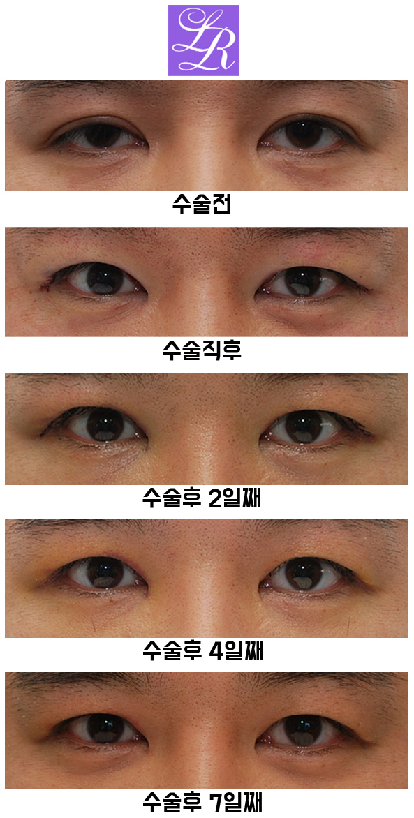 쌍꺼풀푸는수술 후기 - 수술후 1주일차 붓기, 멍 경과 관련 이미지 3