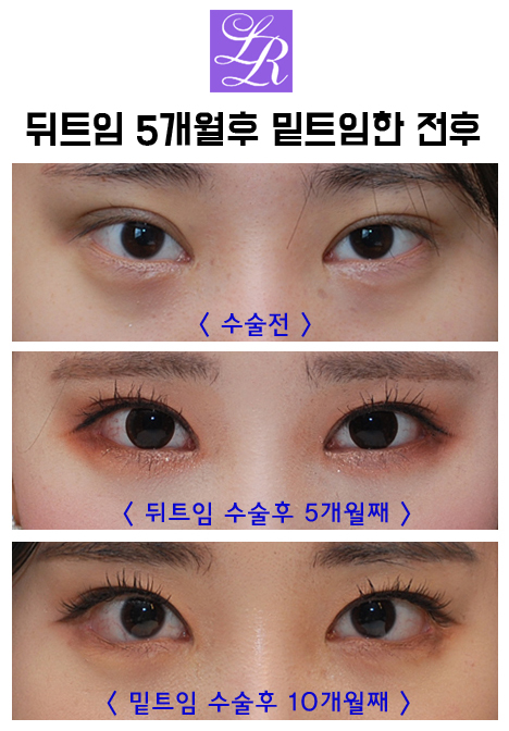 듀얼트임? 뒷트임? 밑트임? 수술 효과 및 재발가능성 관련 이미지 6