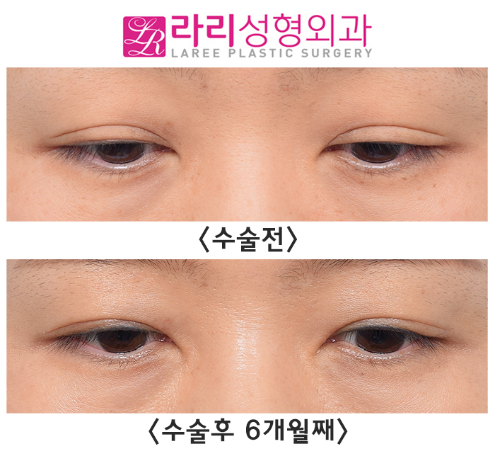 [라리성형외과] 흐릿한 눈, 소세지 쌍꺼풀 인라인 속쌍으로 깔끔하게 관련 이미지 2