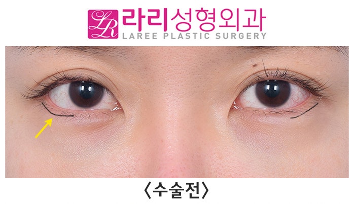 [라리성형외과] 다각도에서 바라보는 비대칭 뒤트임수술 관련 이미지 4