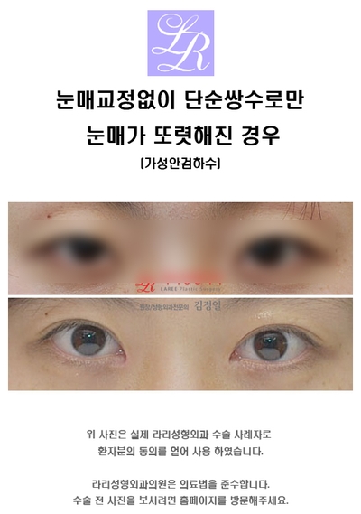 뒤트임 눈매교정 함께 관련 이미지 4
