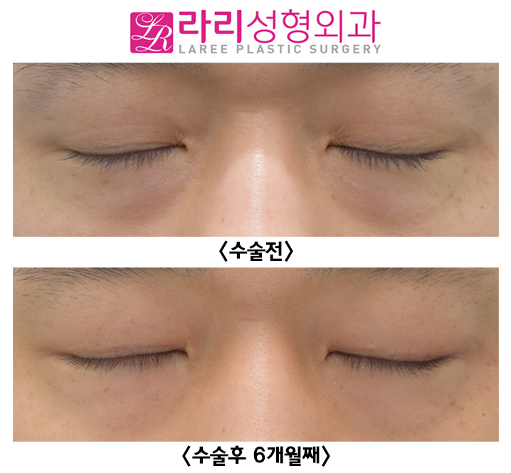 [라리성형외과] 두꺼운 자연 쌍꺼풀 완전 무쌍으로 만드는 쌍꺼풀제거수술 전후사진 관련 이미지 2