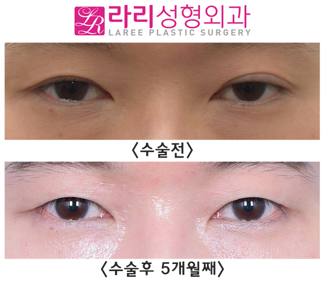 [라리성형외과] 나는 쌍꺼풀없애는수술을 하면 어떻게 될까? 관련 이미지 1