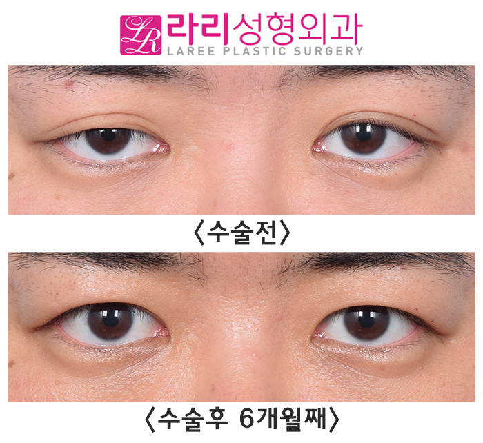 [Rari Plastic Surgery] Difficulty Opening the Eyes, Severe Asymmetry, and Multiple Eyelid Creases: Solved with Crease Removal Surgery! image 1