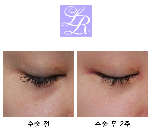 Can medial canthoplasty revision, lateral canthoplasty revision, and under-eye fat repositioning be done at the same time? image 2