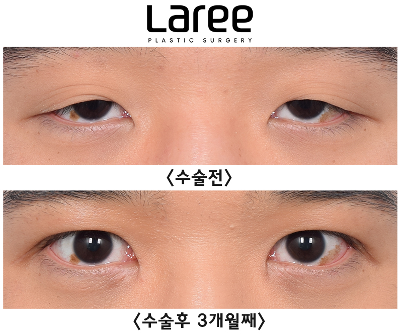 [Lari Plastic Surgery] Eyelid Correction Surgery and Upper Canthoplasty: Experiencing the Maximum Effect of Non-Double-Eyelid Eyelid Correction Without Medial Drooping image 10