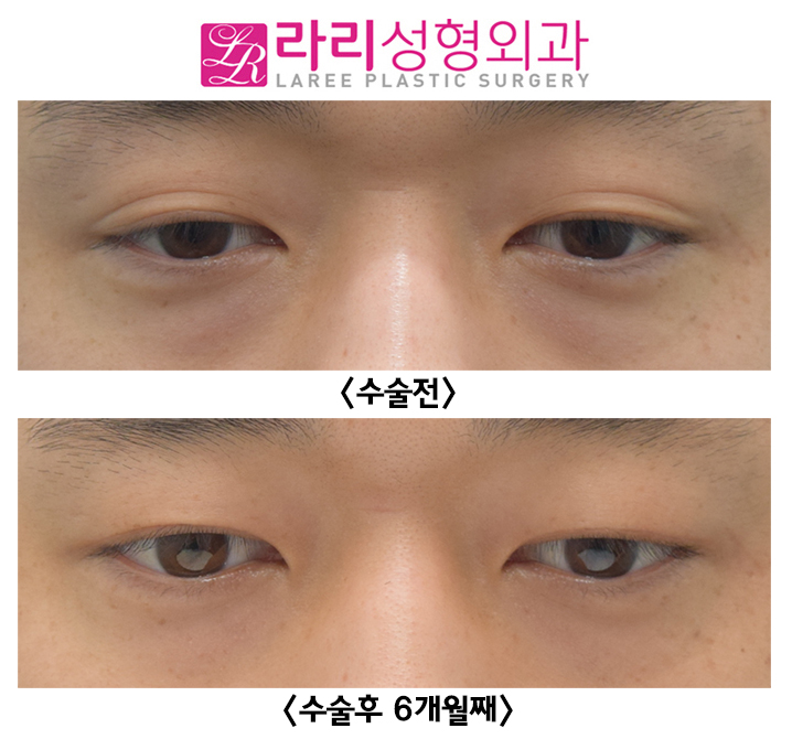 [라리성형외과] 두꺼운 자연 쌍꺼풀 완전 무쌍으로 만드는 쌍꺼풀제거수술 전후사진 관련 이미지 3