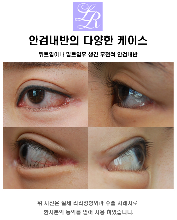 안검내반의 주증상은 속눈썹 찔림 - 수술 교정 관련 이미지 1