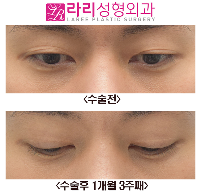 [Rari Plastic Surgery] Before and After Right Non-incisional Double Eyelid Reoperation image 3