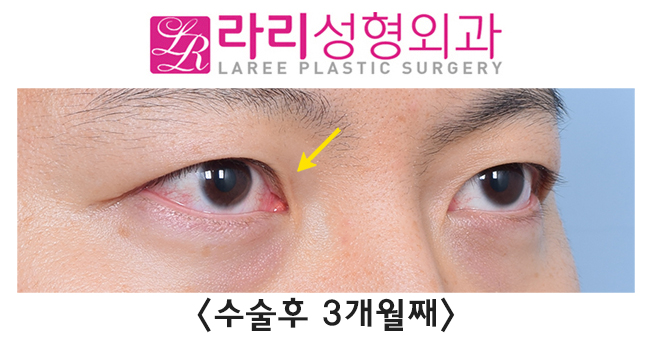 [Rari Plastic Surgery] Recovery Process for Line Irregularity During the Course of Double Eyelid Removal Surgery image 6