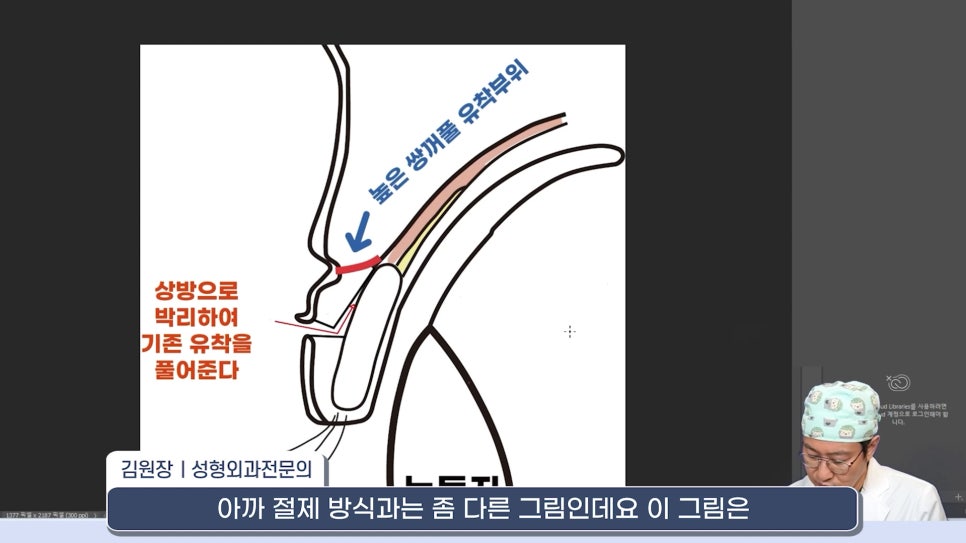 [라리성형외과] 쌍꺼풀재수술 라인 낮추는 두 가지 수술법 (절제방법 , 두줄따기방법) 관련 이미지 4