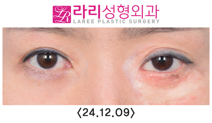 [라리성형외과] 연골이식으로 하안검외반의 일종인 삼백안 교정하기 관련 이미지 7