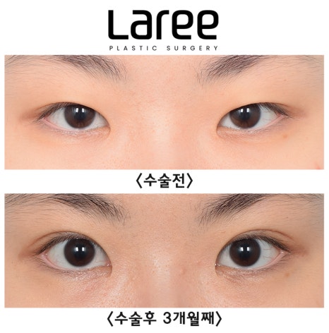 [Lari Plastic Surgery] A Collection of Various Surgeries for Double Eyelids image 1